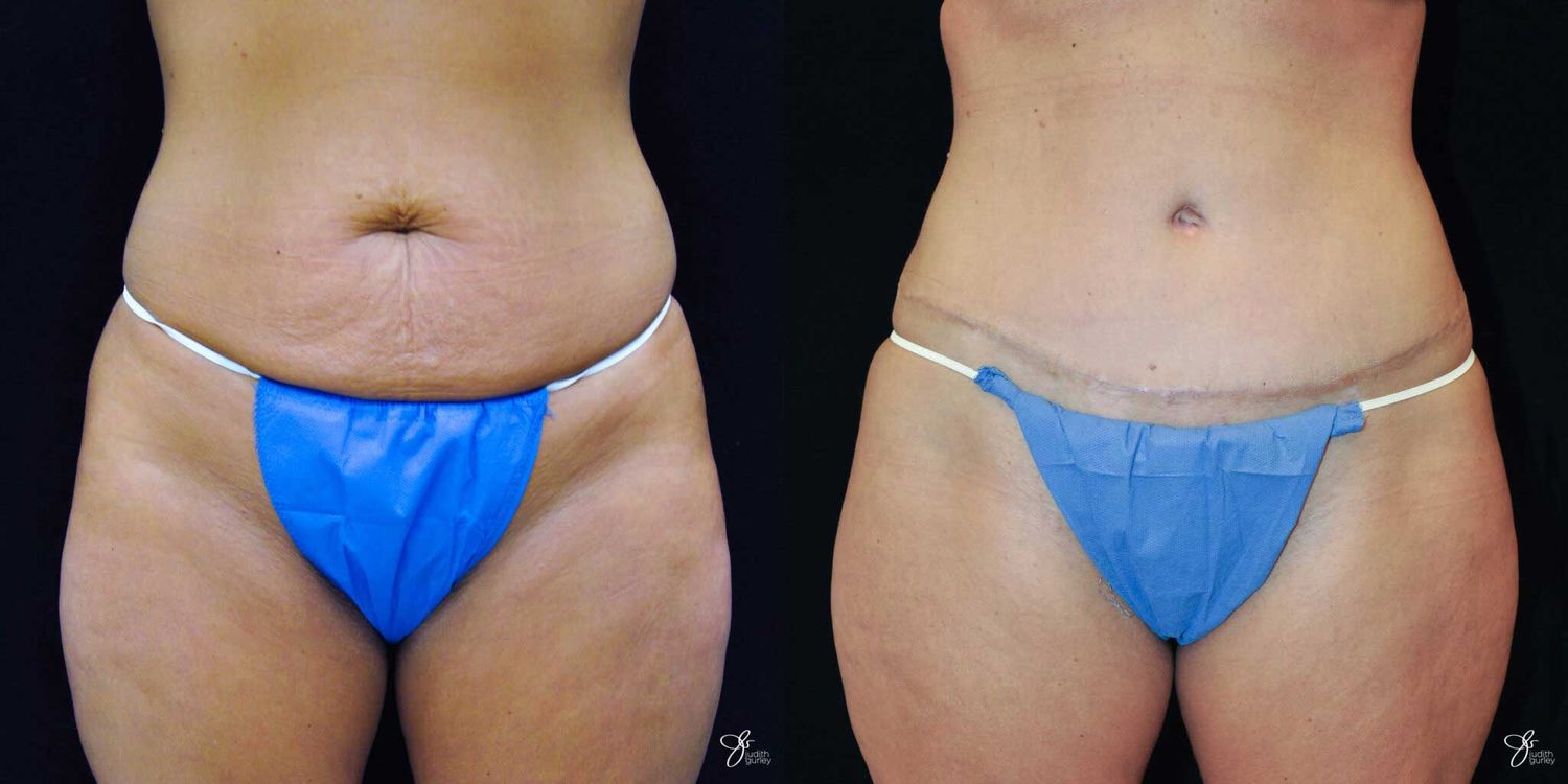 Tummy Tuck Before & After
