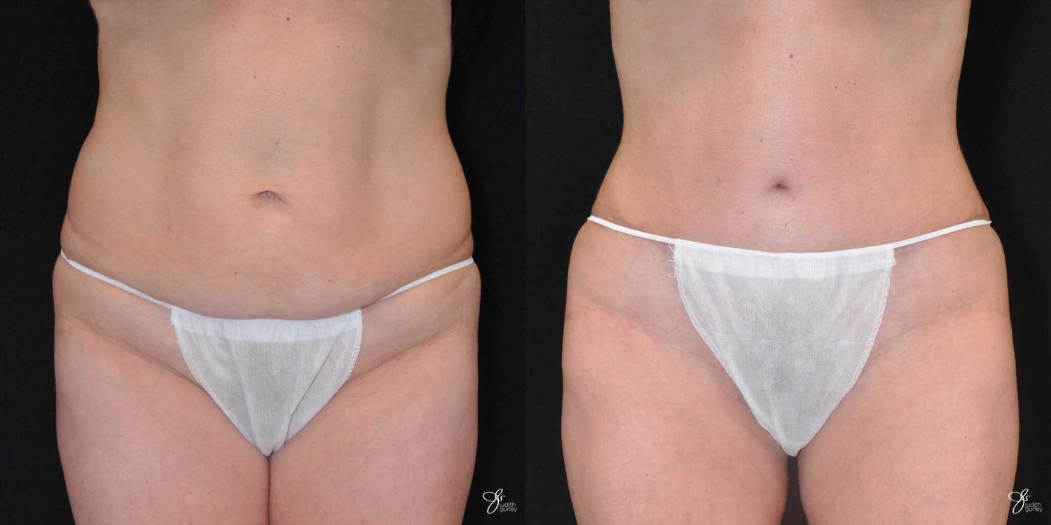 Tummy Tuck Before & After