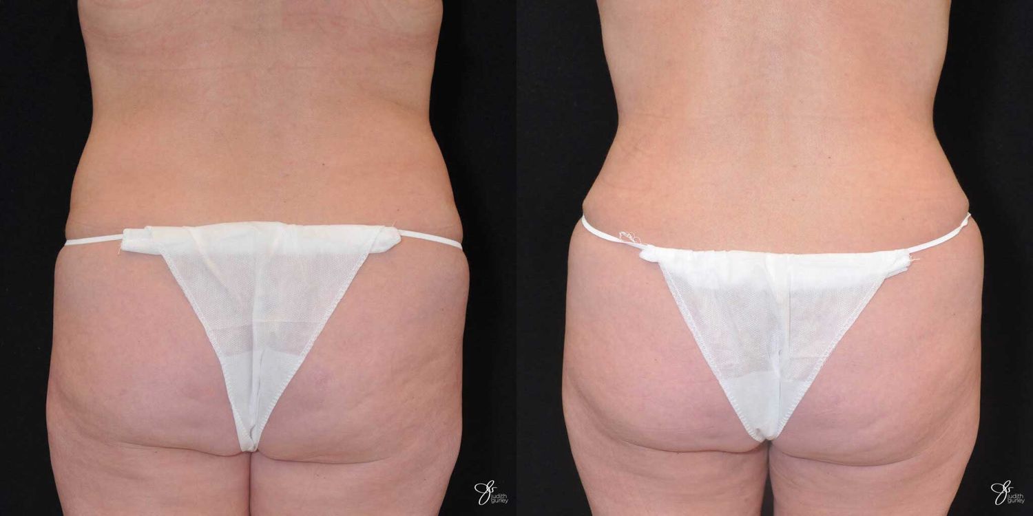 Tummy Tuck Before & After