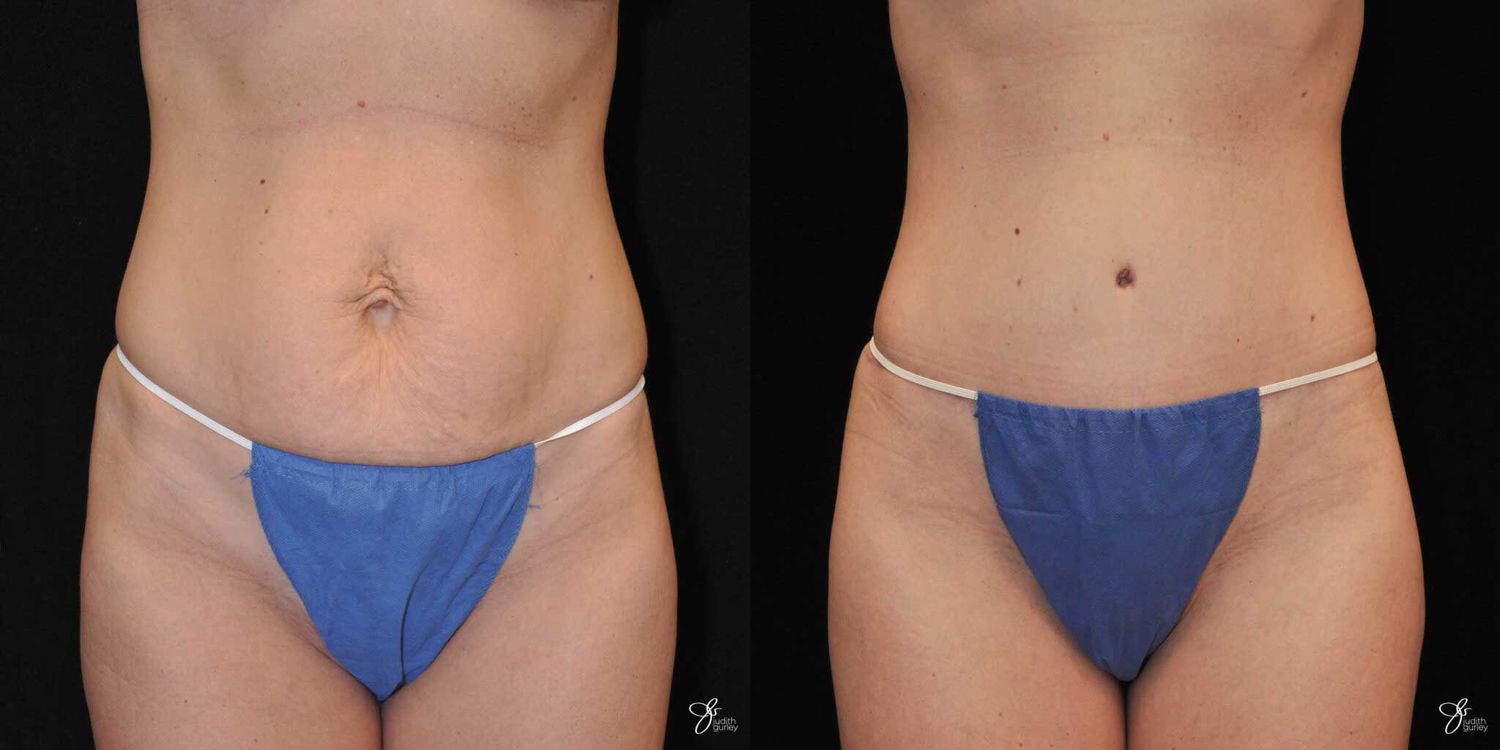 Tummy Tuck Before & After