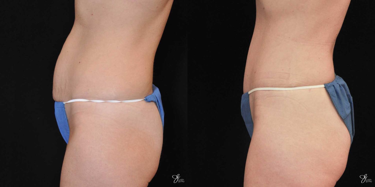 Tummy Tuck Before & After