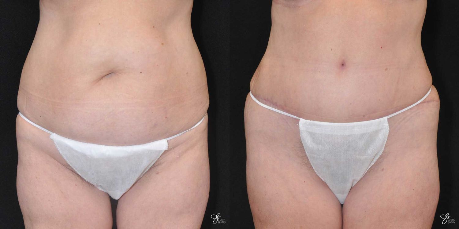 Tummy Tuck Before & After