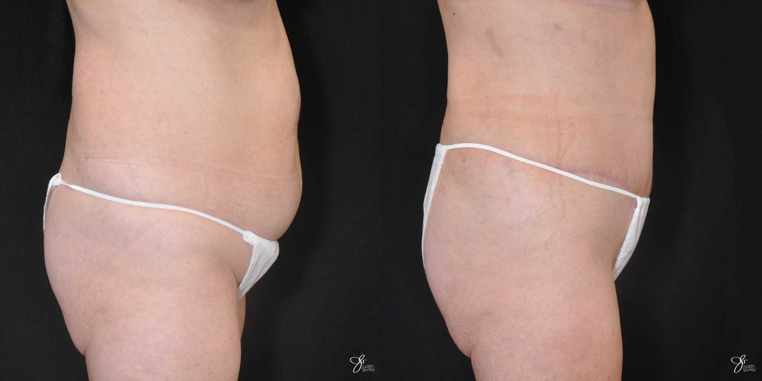 Tummy Tuck Before & After