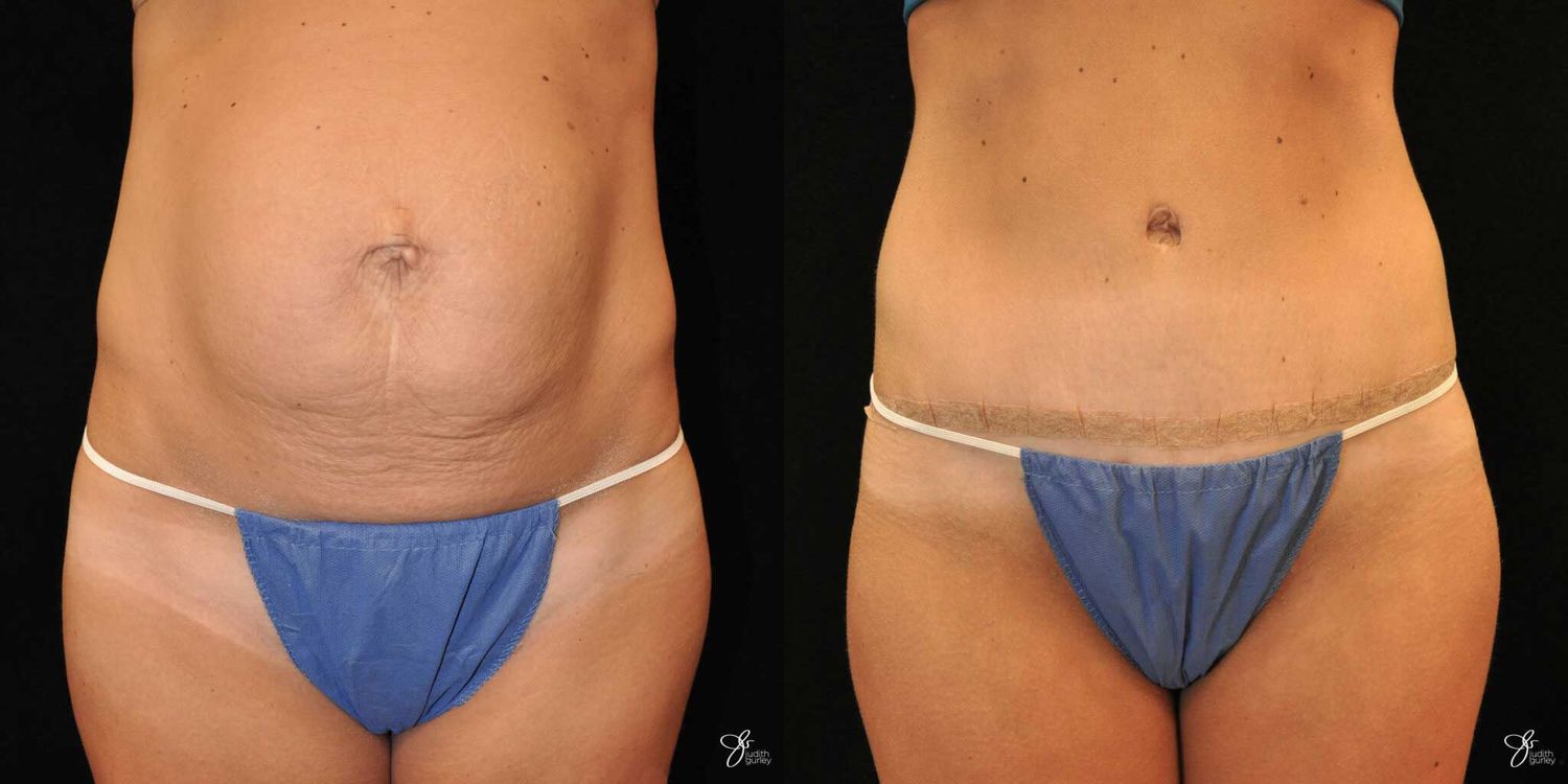 Tummy Tuck Before & After