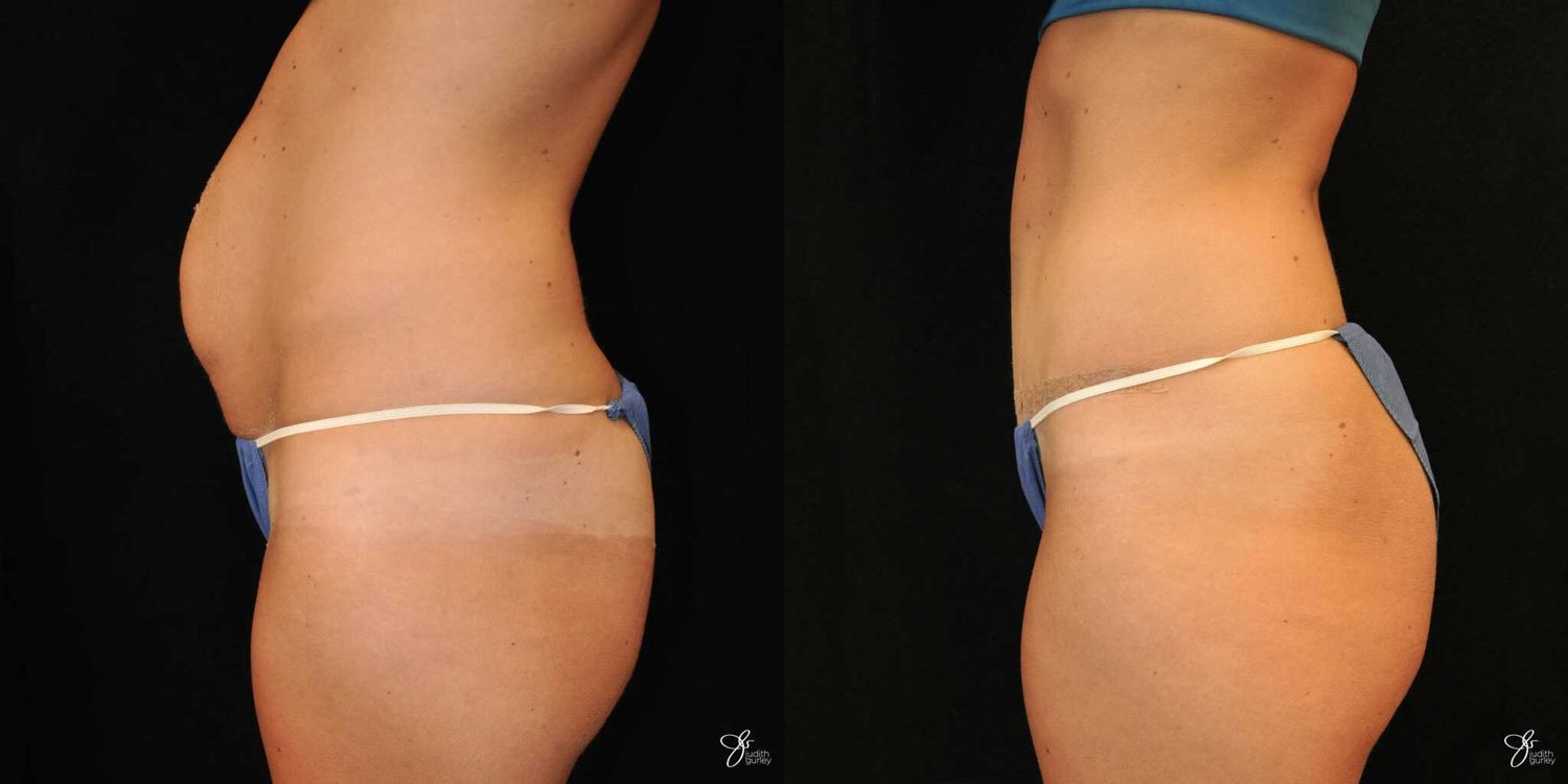 Tummy Tuck Before & After
