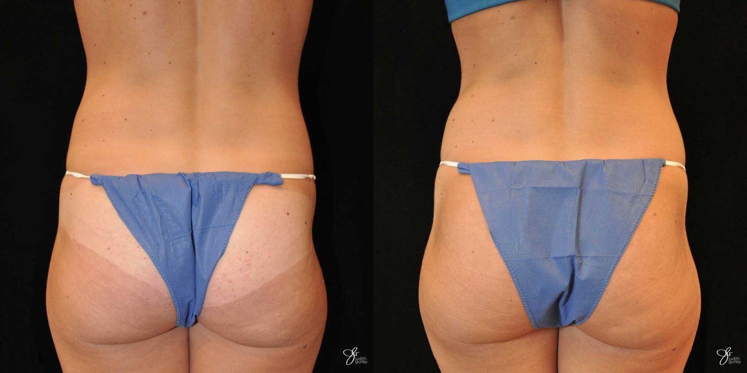 Tummy Tuck Before & After