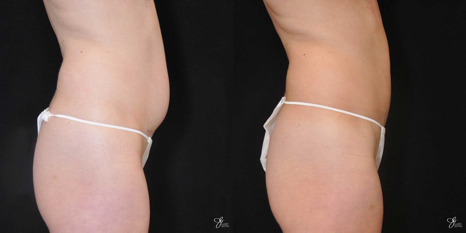 Tummy Tuck Before & After