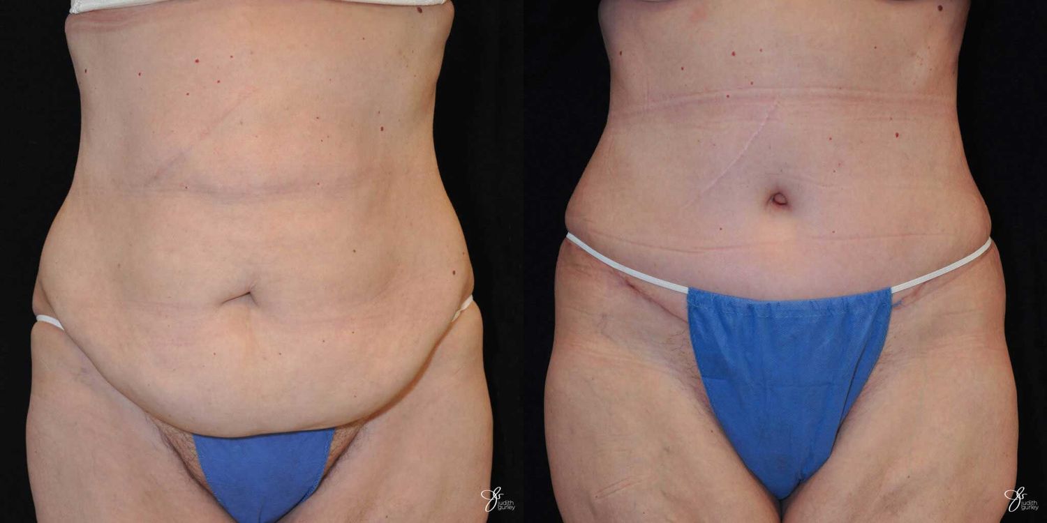 Tummy Tuck Before & After