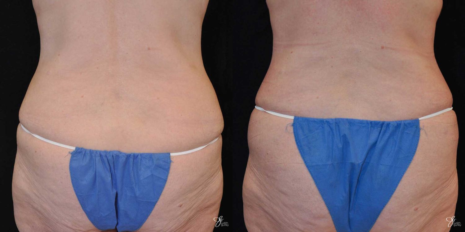 Tummy Tuck Before & After