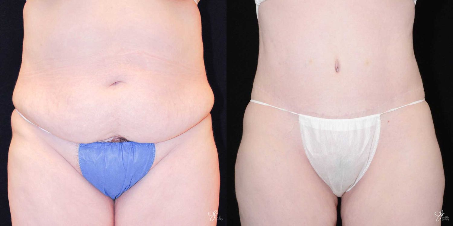 Tummy Tuck Before & After