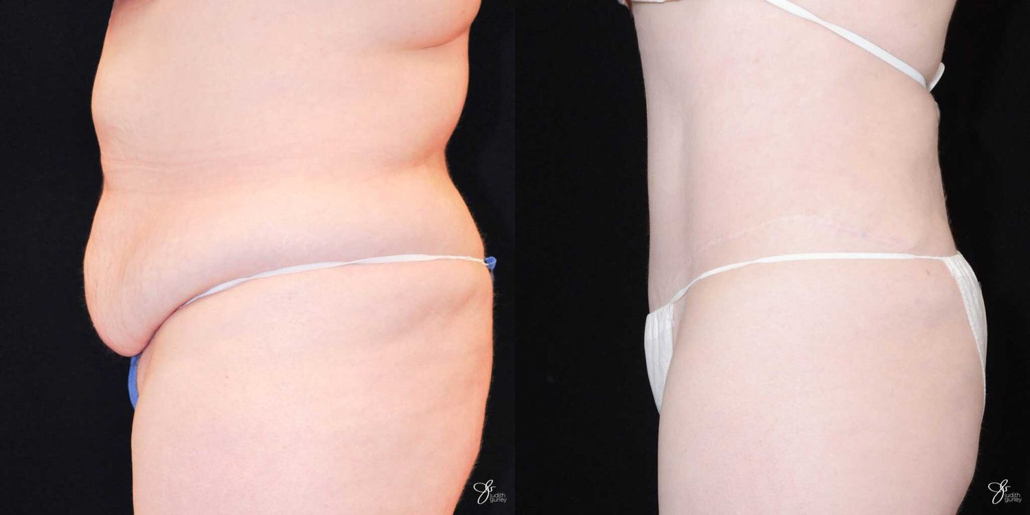 Tummy Tuck Before & After