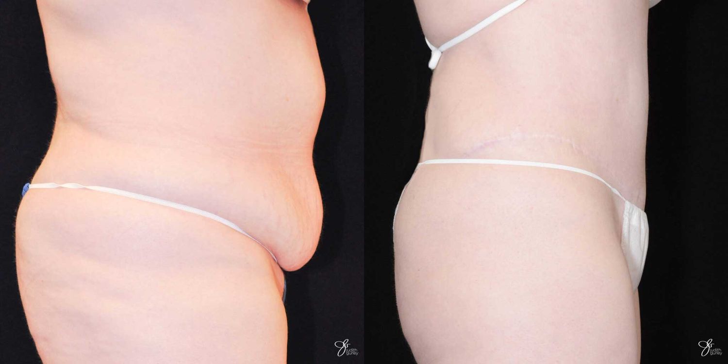 Tummy Tuck Before & After