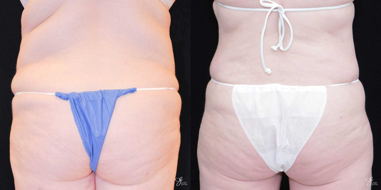 Tummy Tuck Before & After