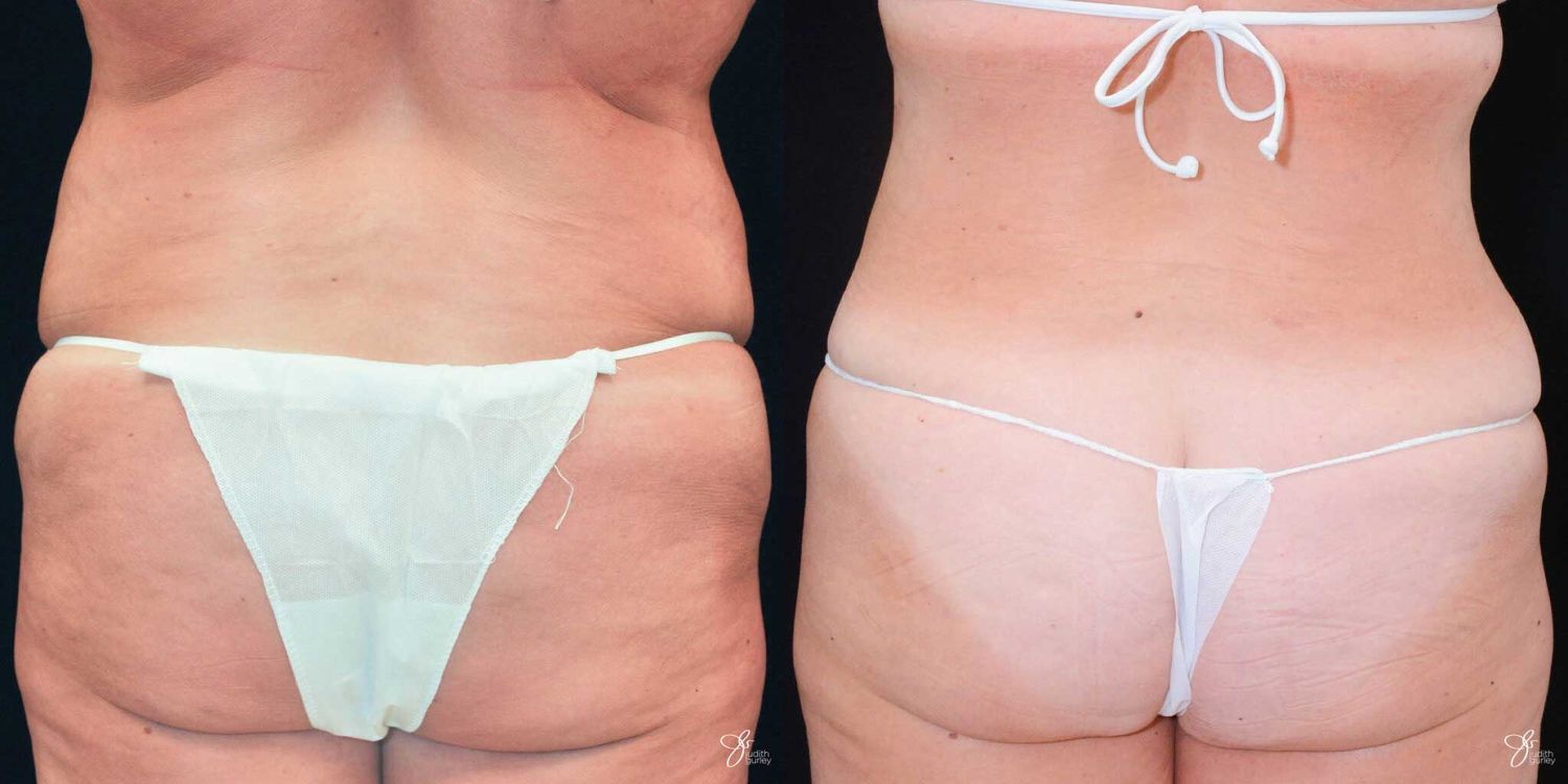 Tummy Tuck Before & After