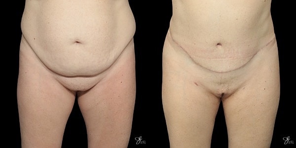 Tummy Tuck Before & After