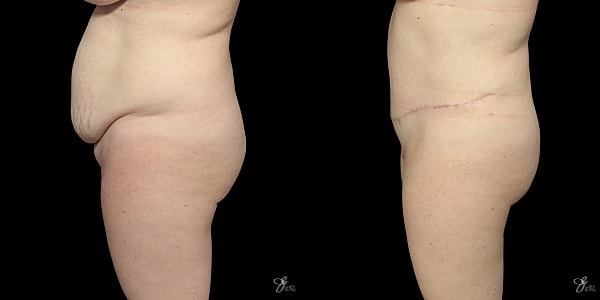 Tummy Tuck Before & After