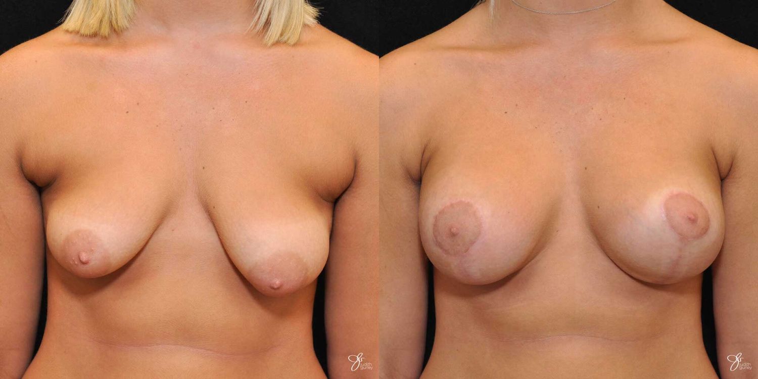 Tubular Breast Correction Before & After