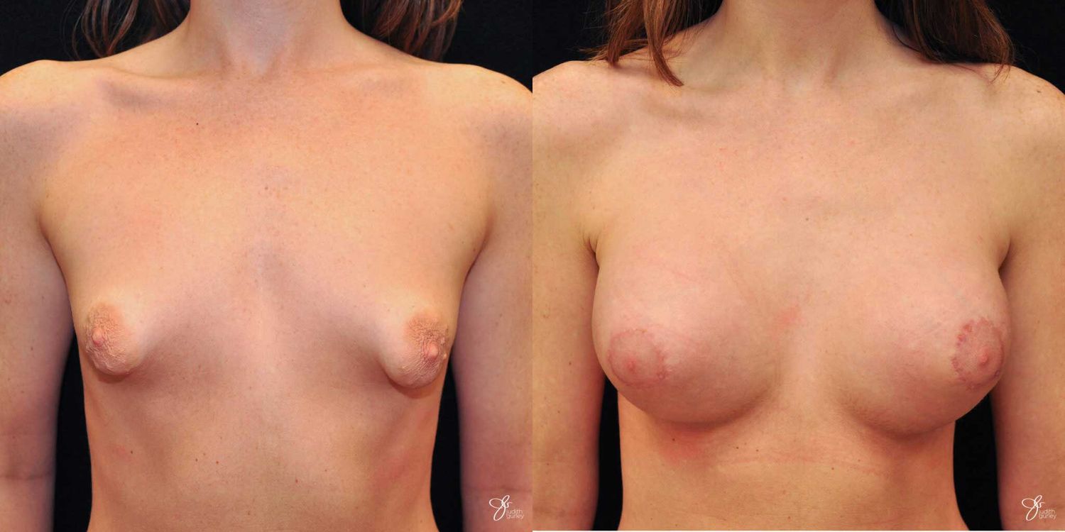 Tubular Breast Correction Before & After