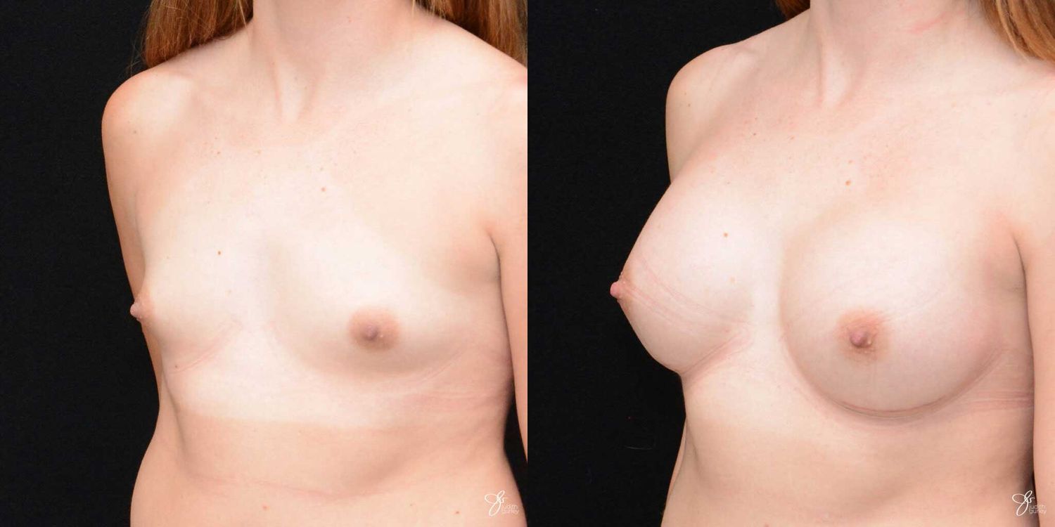 Tubular Breast Correction Before & After