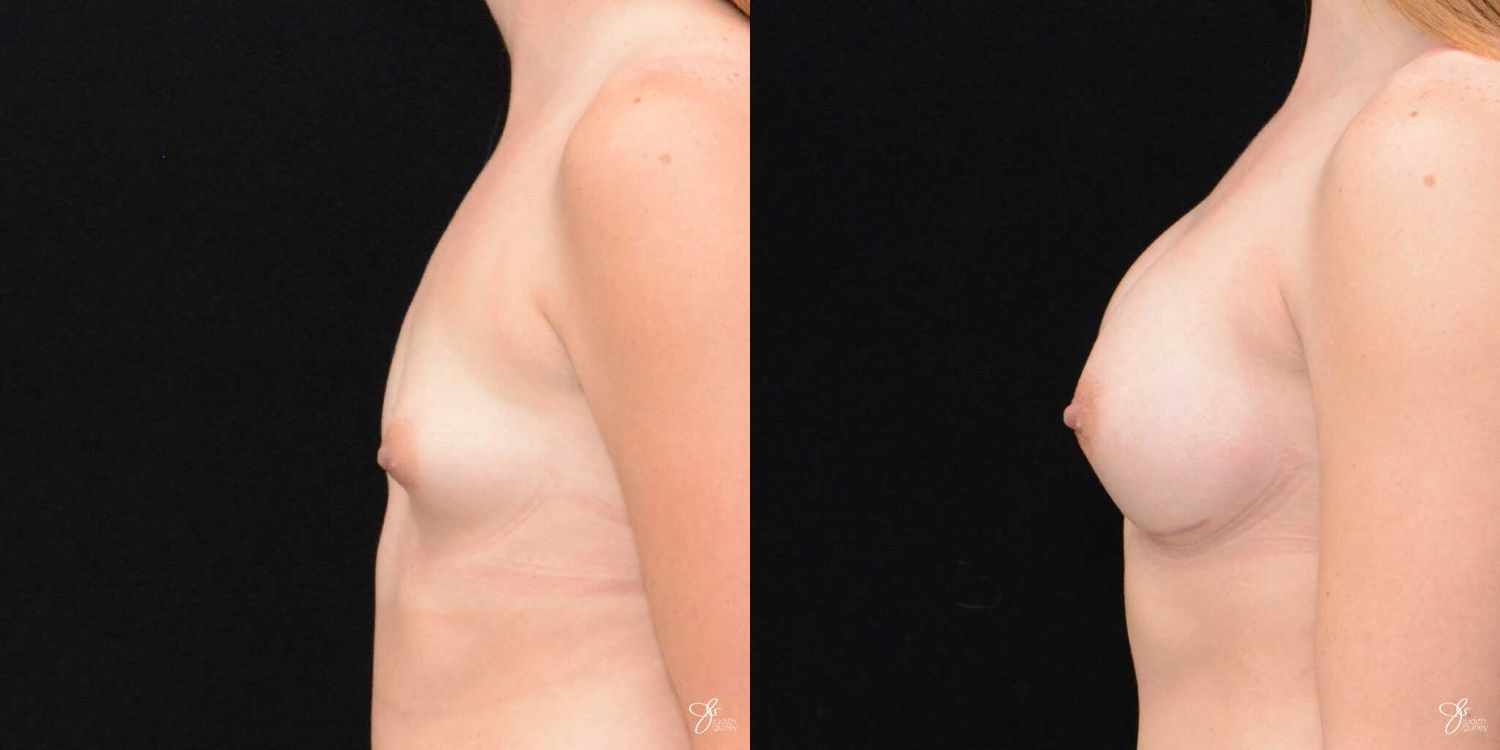 Tubular Breast Correction Before & After
