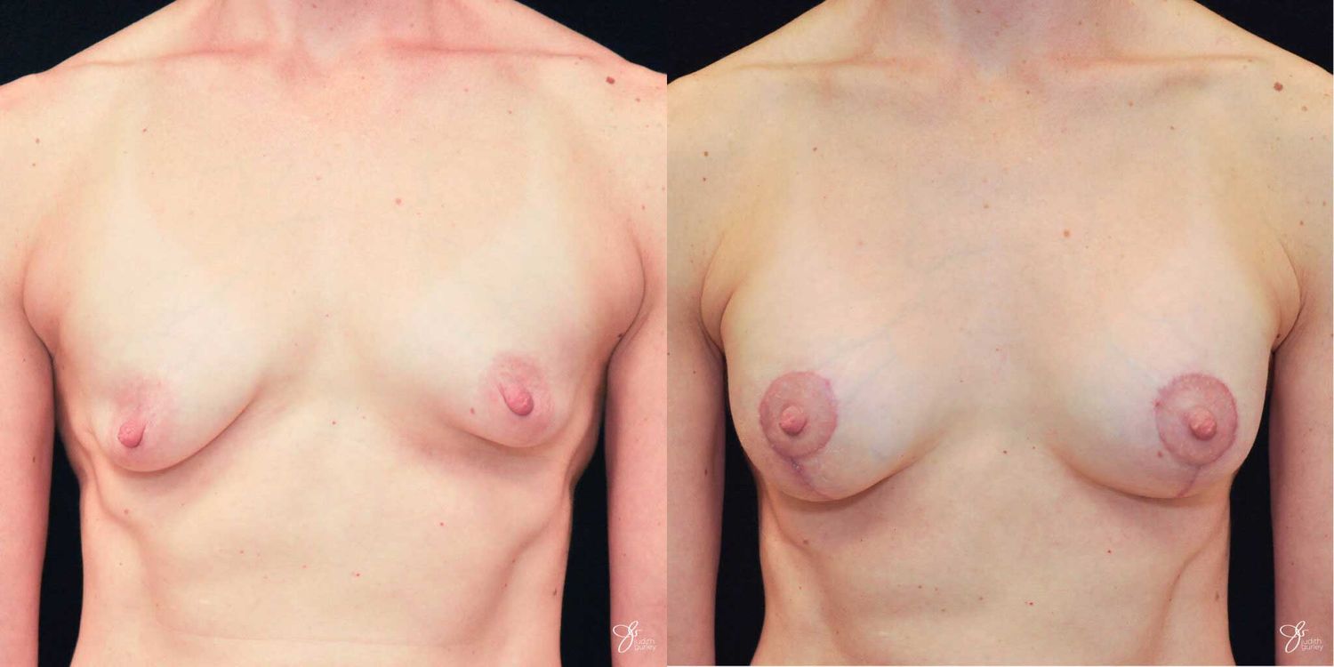Tubular Breast Correction Before & After