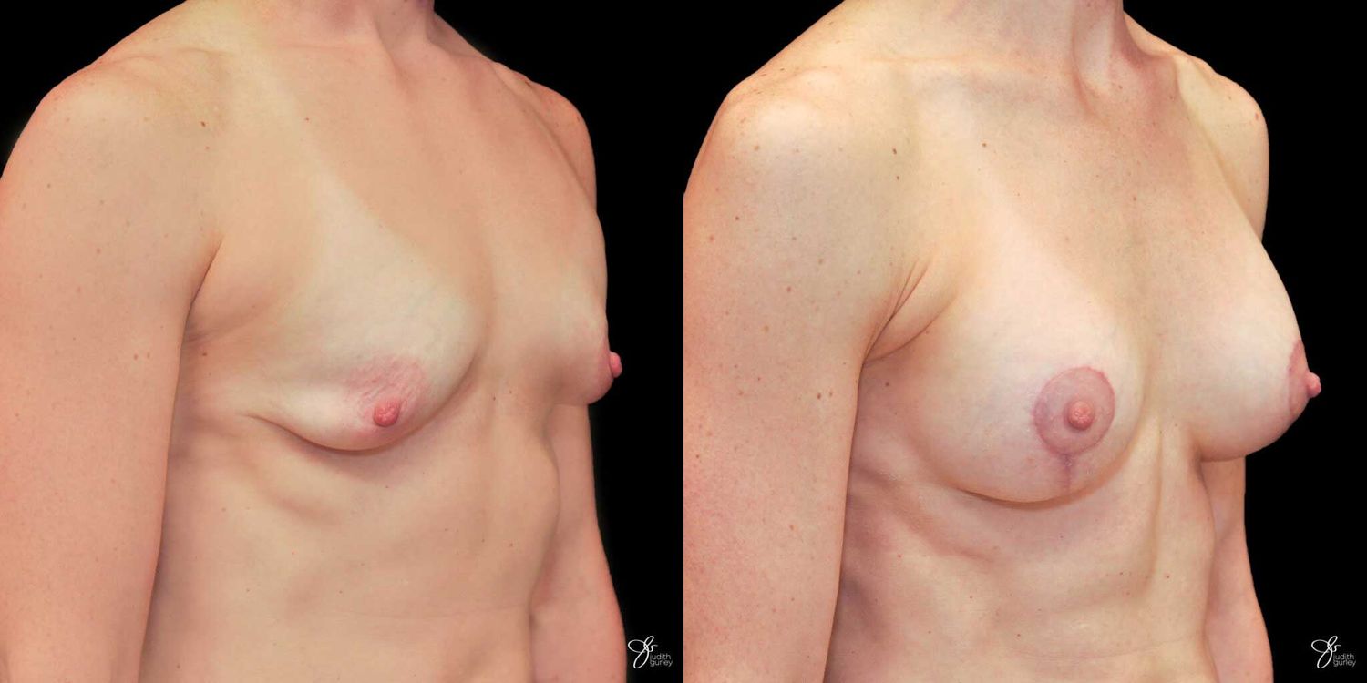 Tubular Breast Correction Before & After