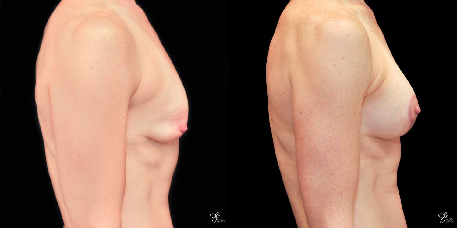 Tubular Breast Correction Before & After
