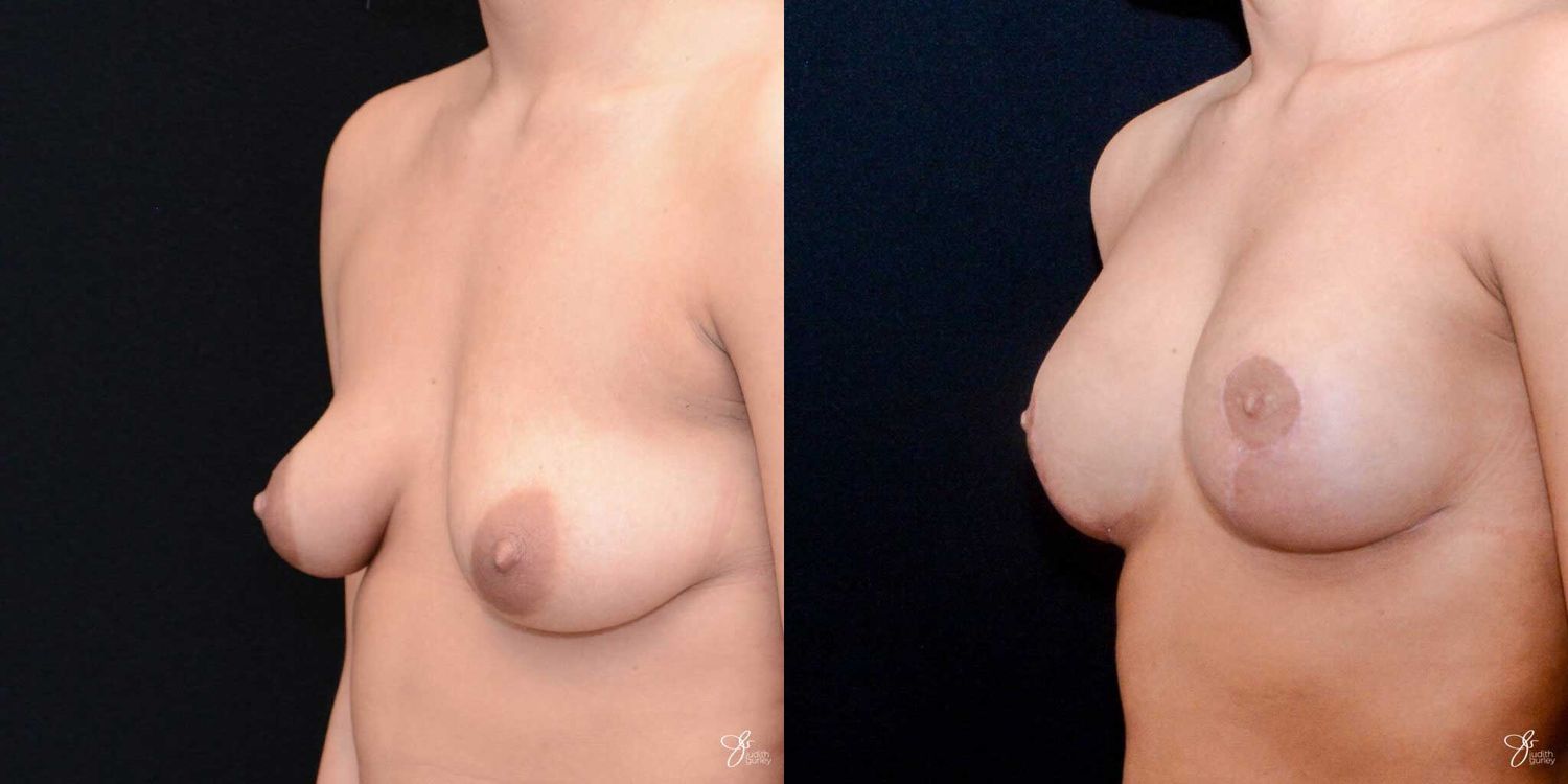 Tubular Breast Correction Before & After