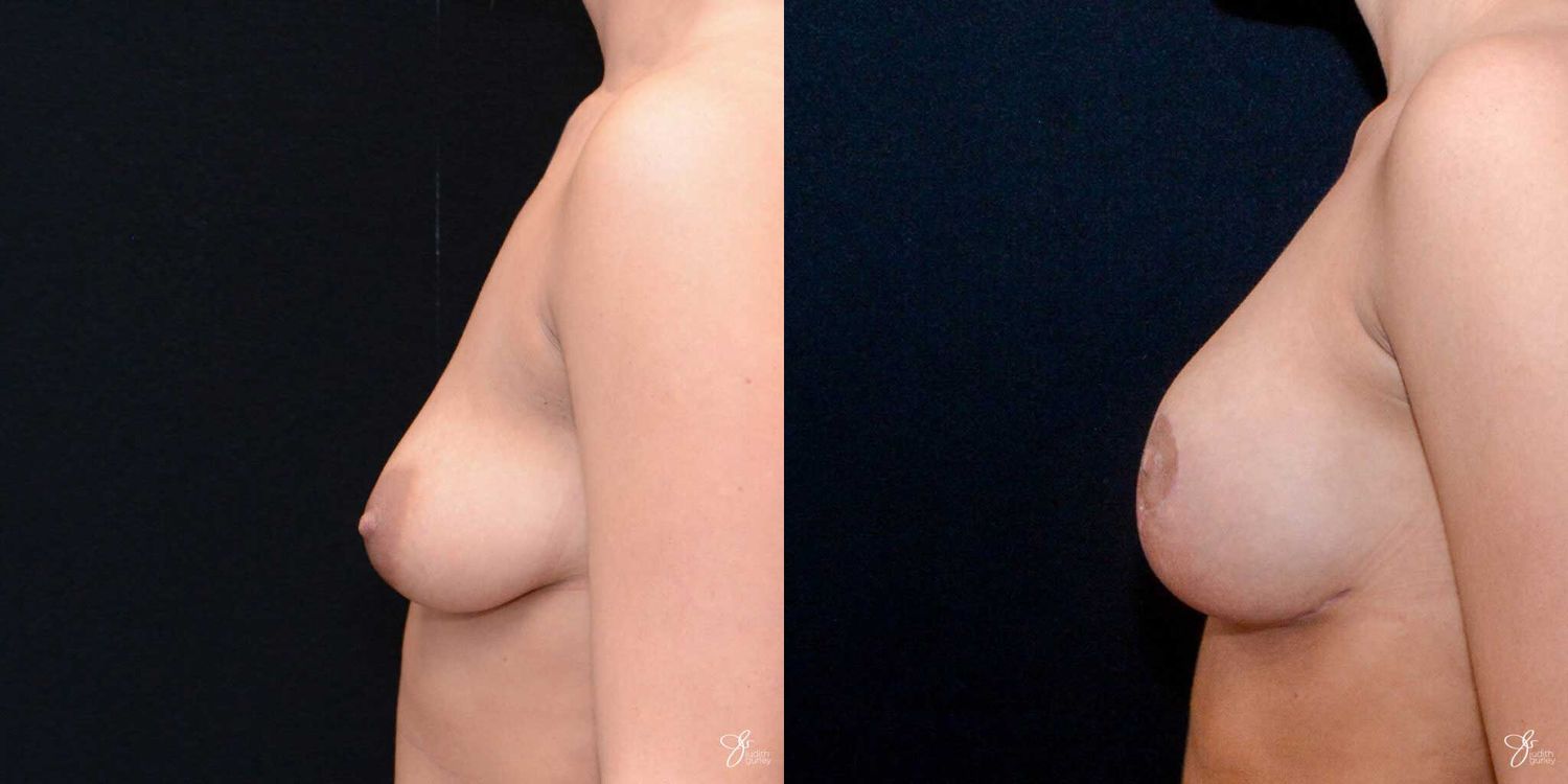 Tubular Breast Correction Before & After