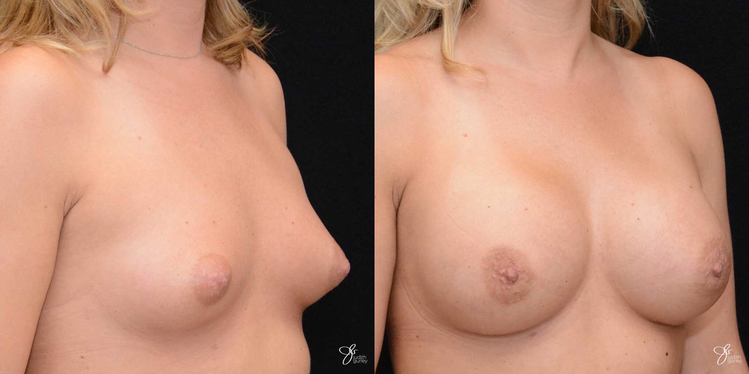 Tubular Breast Correction Before & After