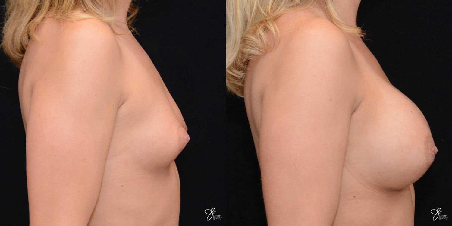 Tubular Breast Correction Before & After