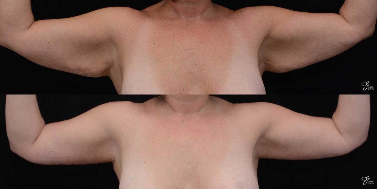Arm Lift Before & After