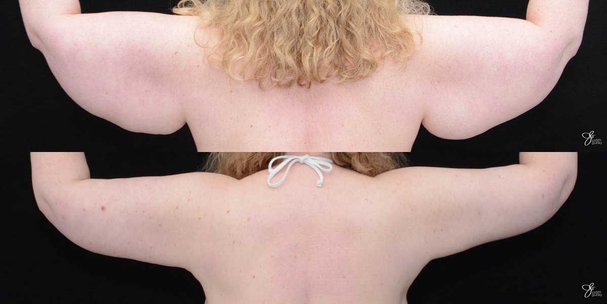 Arm Lift Before & After