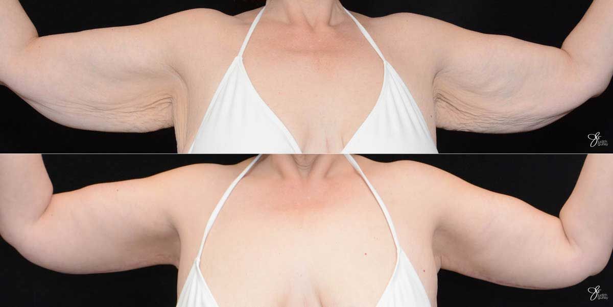 Arm Lift Before & After