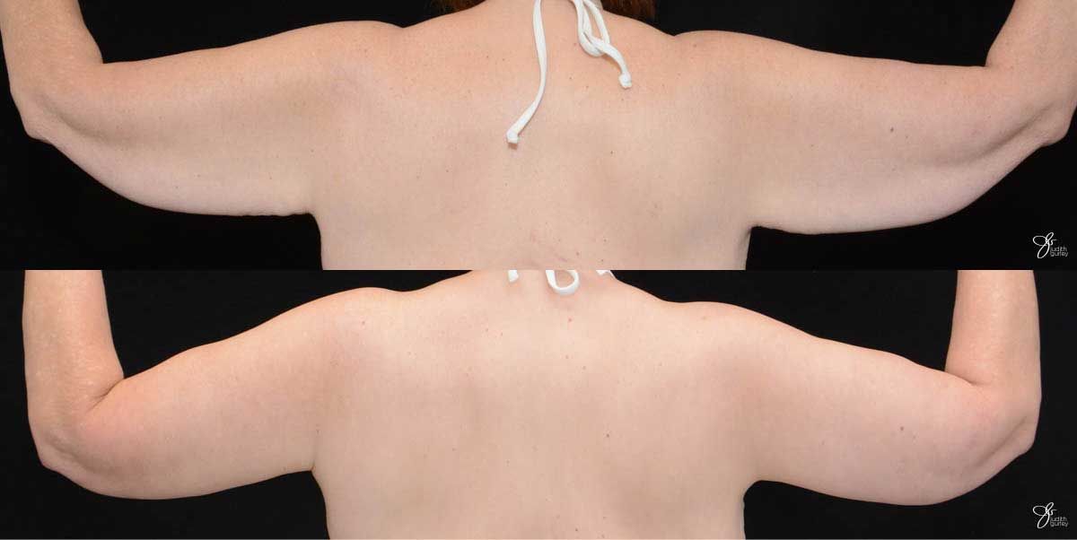 Arm Lift Before & After