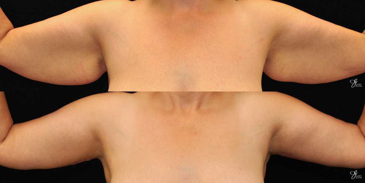 Arm Lift Before & After