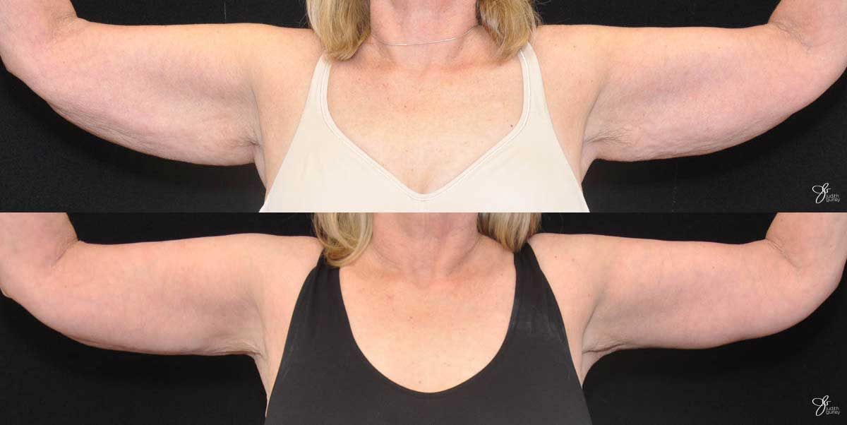 Arm Lift Before & After