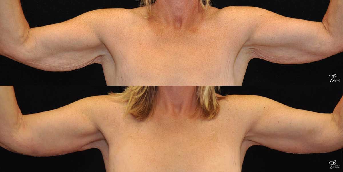 Arm Lift Before & After