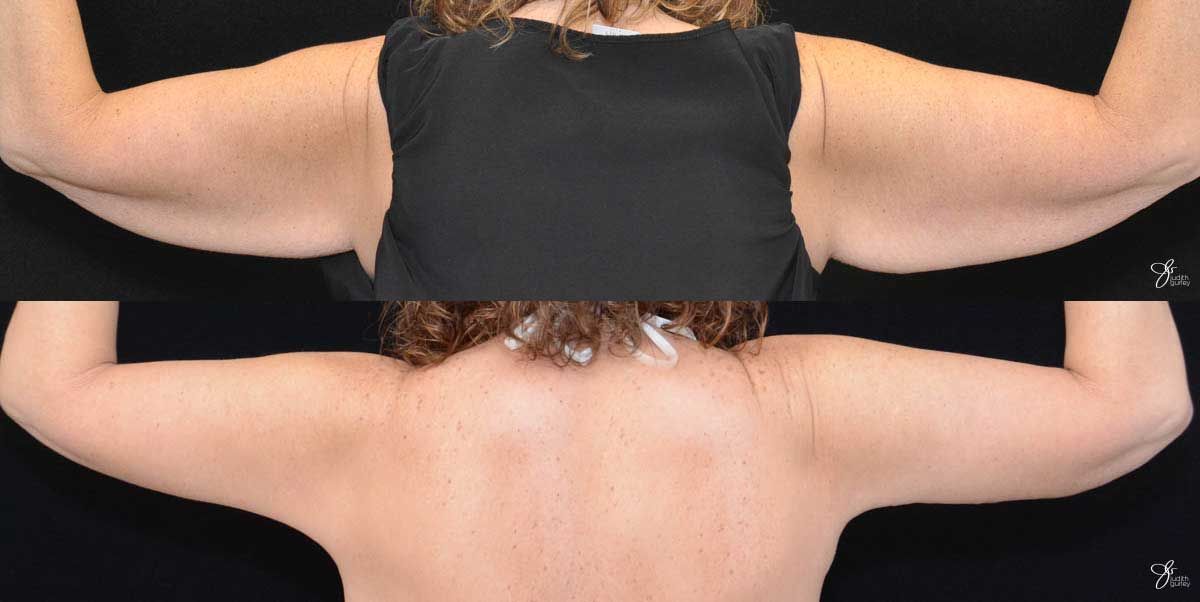 Arm Lift Before & After