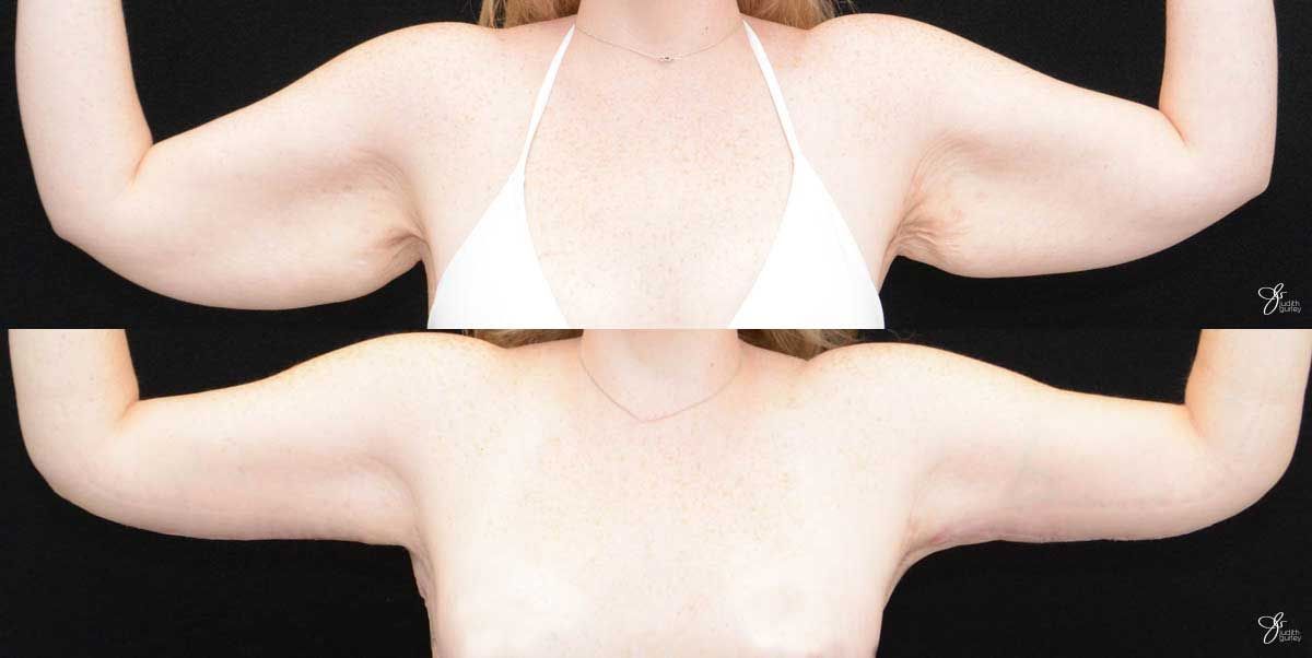 Arm Lift Before & After