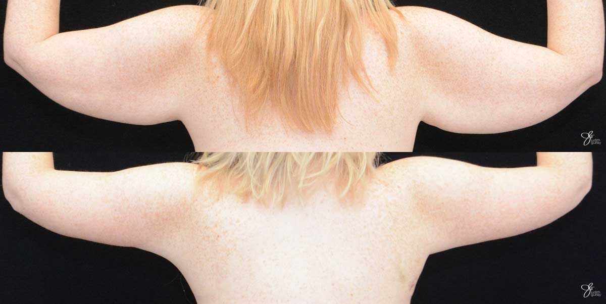 Arm Lift Before & After