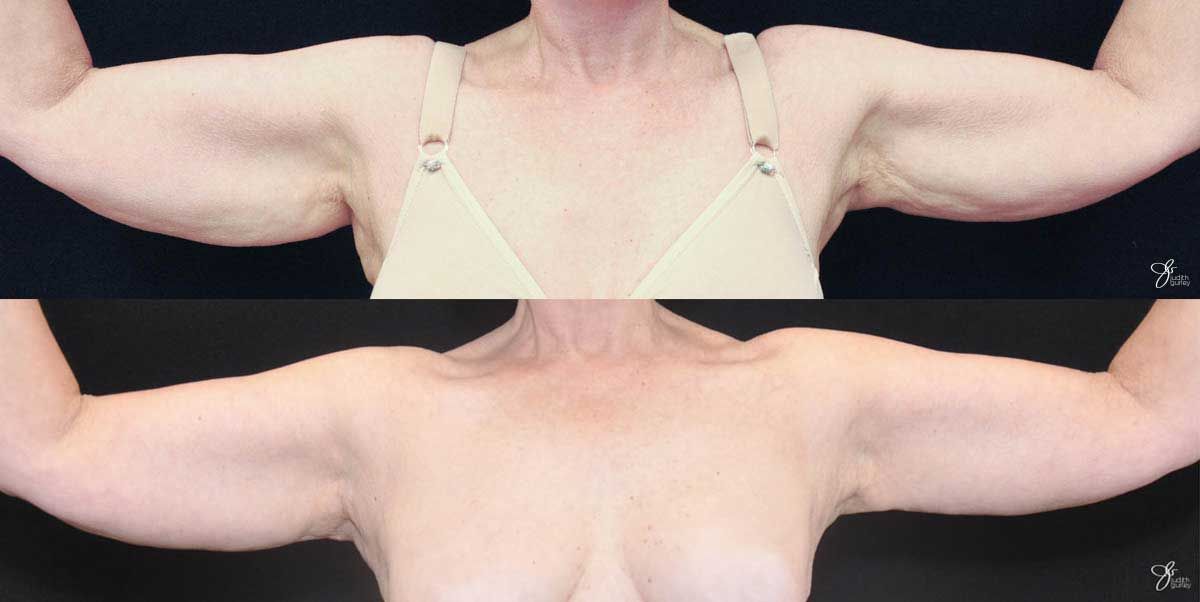 Arm Lift Before & After