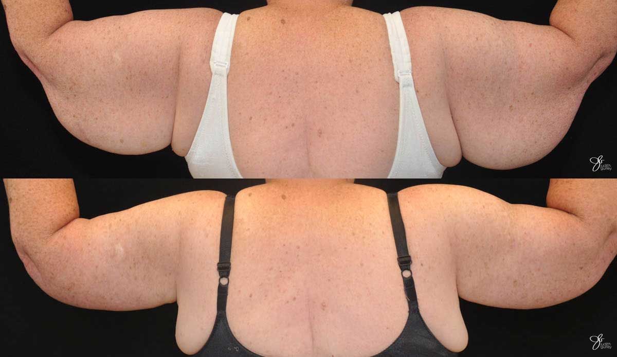 Arm Lift Before & After