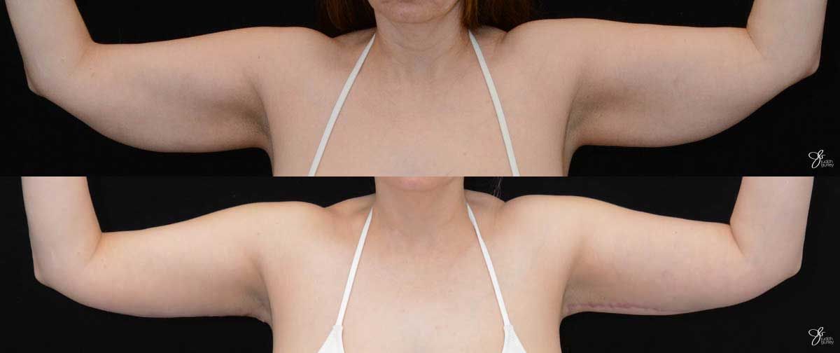 Arm Lift Before & After