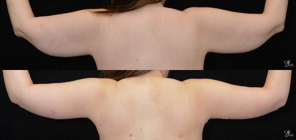 Arm Lift Before & After