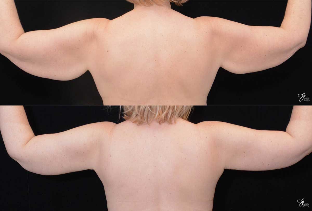Arm Lift Before & After