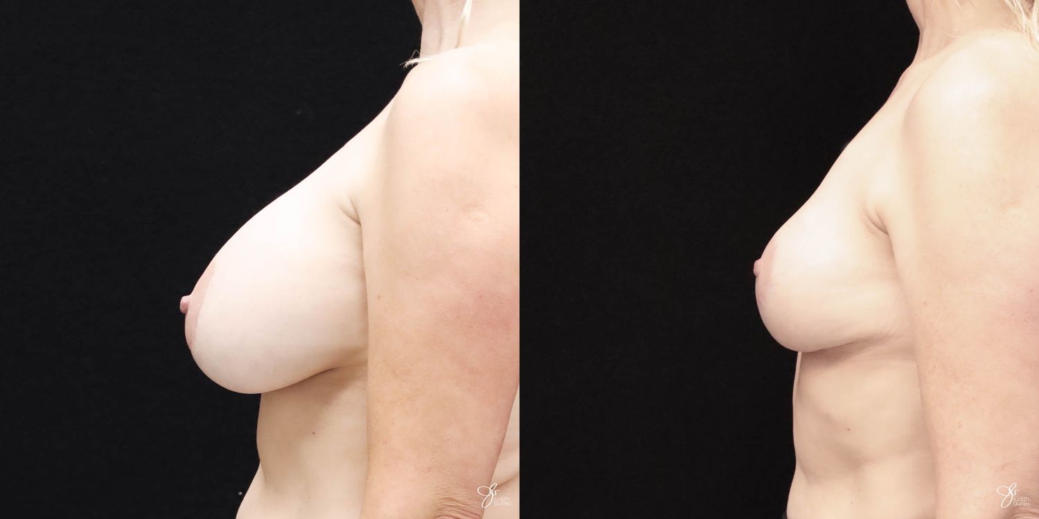 Breast Implant Removal With Lift Before & After