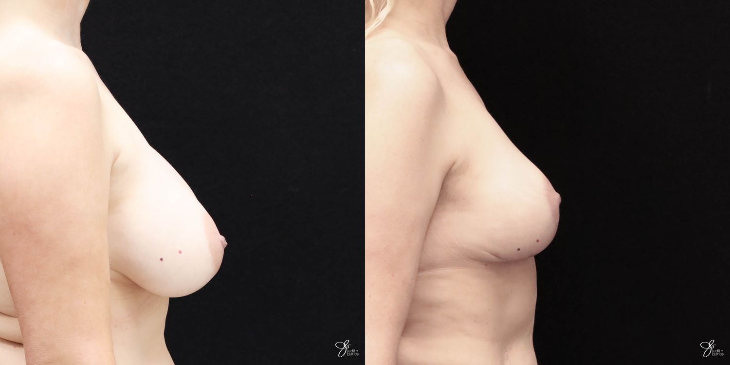 Breast Implant Removal With Lift Before & After