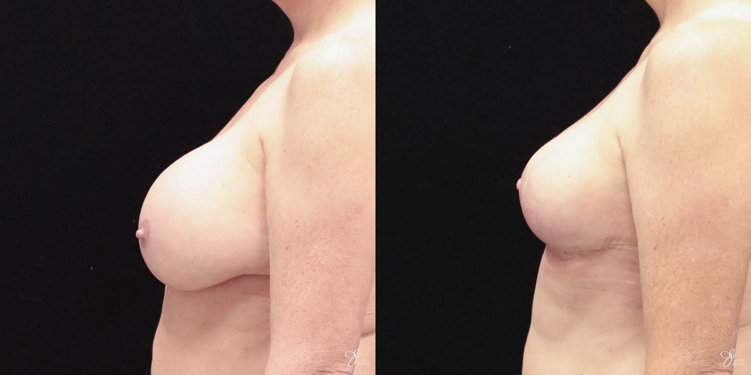 Breast Implant Removal With Lift Before & After