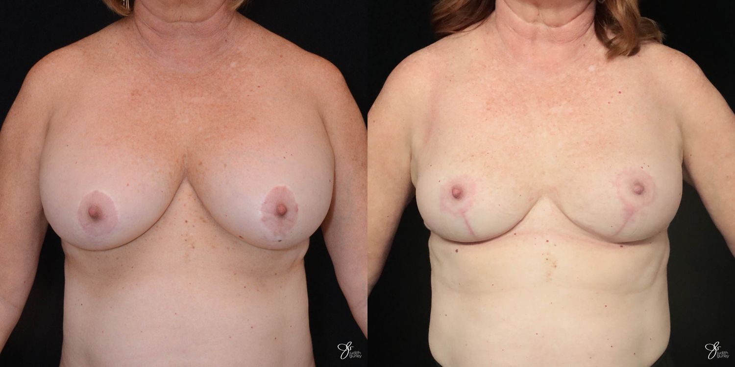 Breast Implant Removal With Lift Before & After